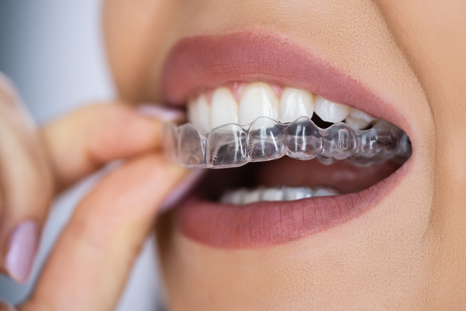 TOOTH ALIGNERS