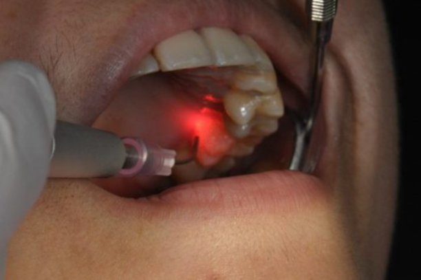 LASER TREATMENT